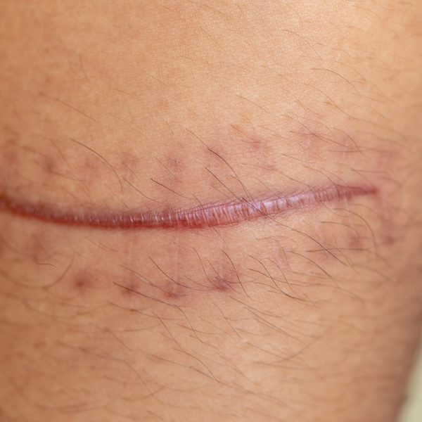 A scar is an area of fibrous tissue that replaces normal skin after an injury on skin.
