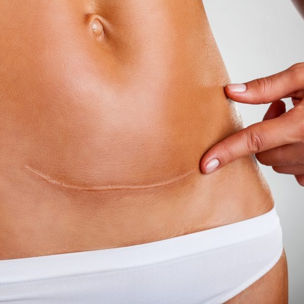Closeup of woman belly with a scar from a cesarean section
